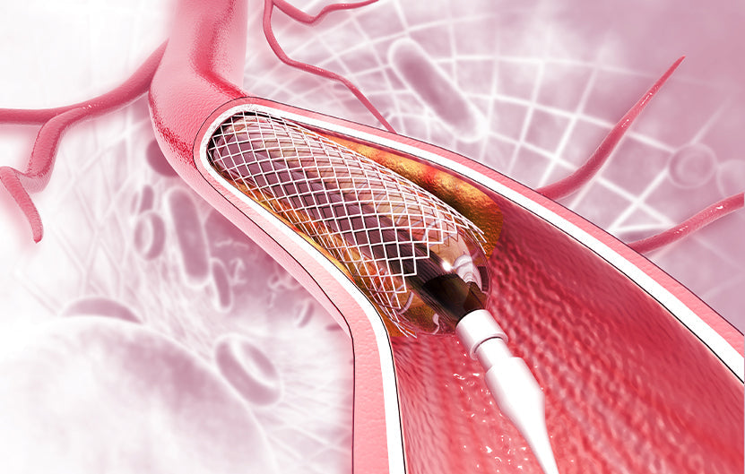 Stent Blocked Again? What You Should Know About Recurrent In-Stent Restenosis
