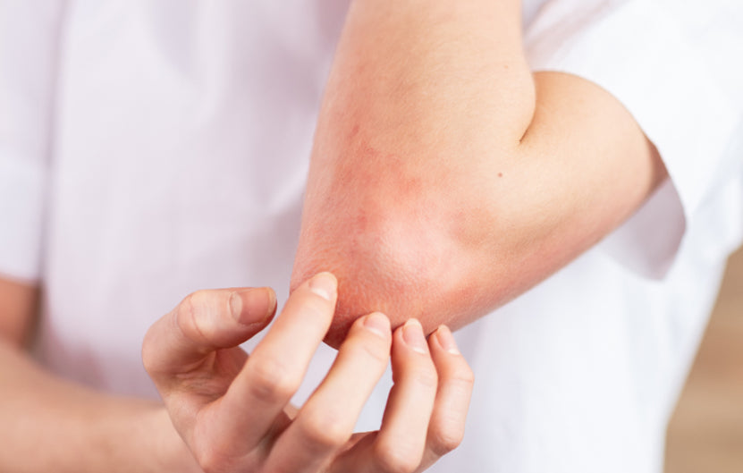 Six Common Questions About Urticaria: What You Should Know About Hives